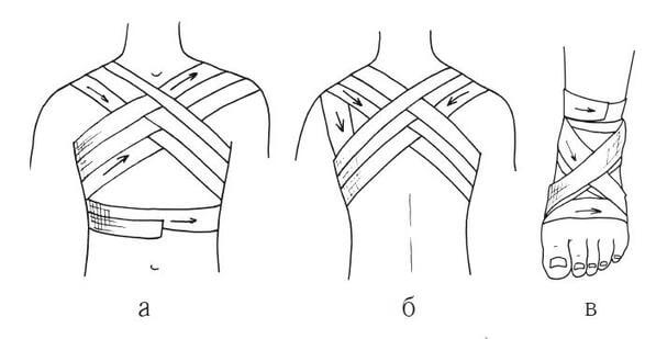 Типы бинтовых повязок: крестообразная