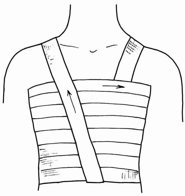 Типы бинтовых повязок: спиральная на грудную клетку