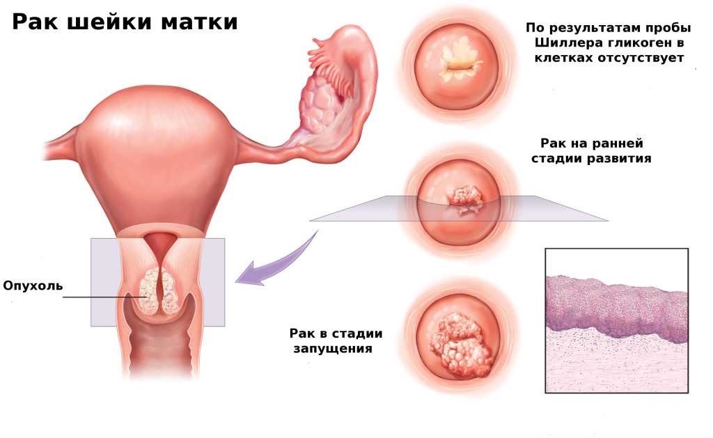 cancer-cervix