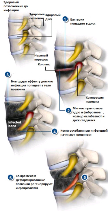 Инфекции позвоночника - симптомы