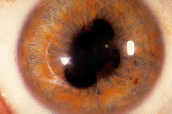 Колобома глаза - причины, симптомы, диагностика и лечение дефекта