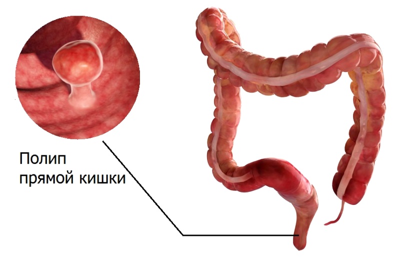 Полип прямой кишки