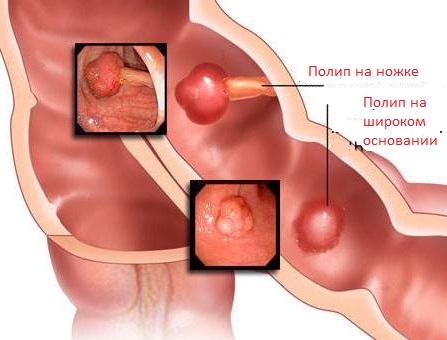 Ювенильные полипы у ребенка