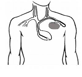 PPM-In-Chest