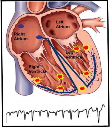 Polymorphic-VT-with-EKG