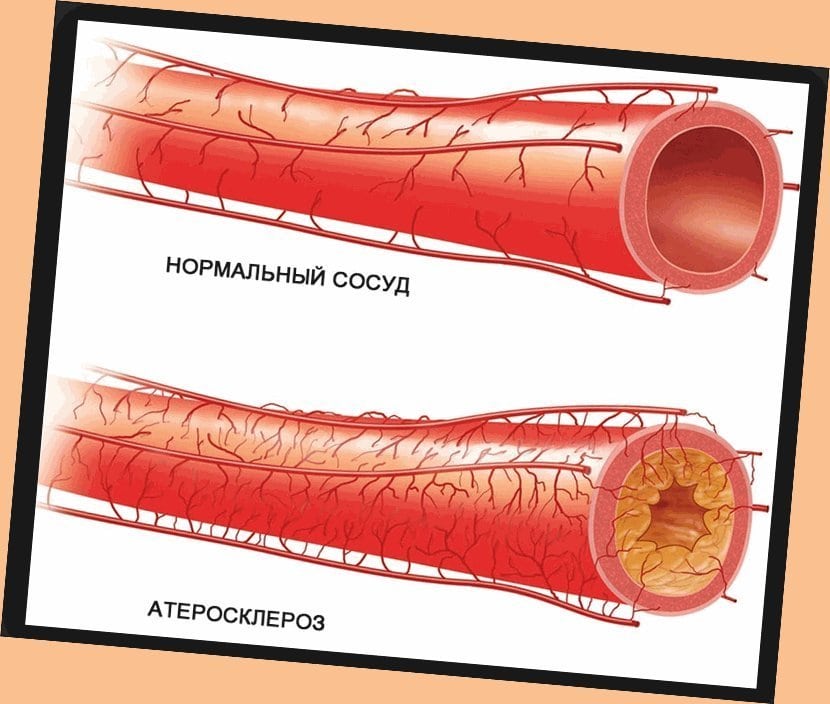 Атеросклероз со. Сужение кровеносных сосудов.