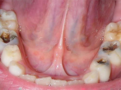 Кариес зубов дает неприятный запах изо рта
