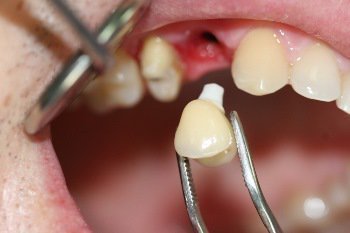 Имплантация зубов осуществляется при агрессивном пародонтите