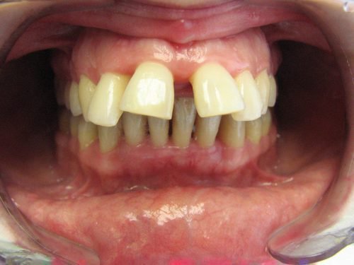 Агрессивная форма пародонтита - потеря зубов