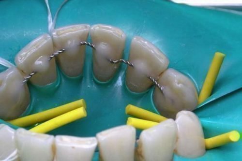 Шинирование зубов - завершающая стадия лечения пародонтита