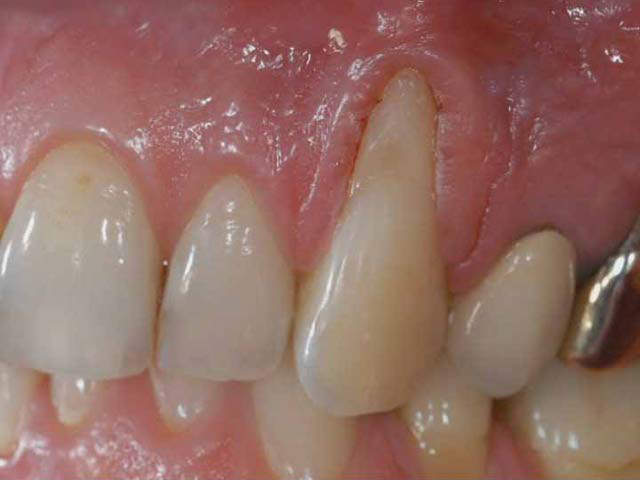 Зубной дефект
