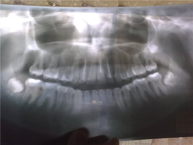 Рентген челюсти 